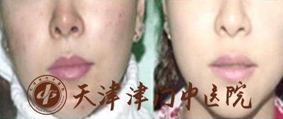 在日常生活中怎么预防痘痘